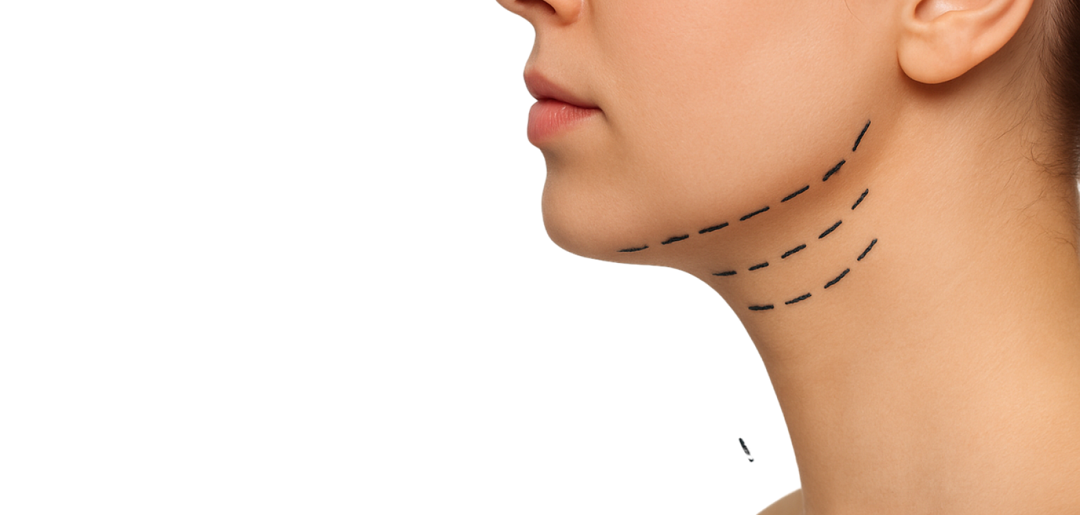 Липосакция подбородка