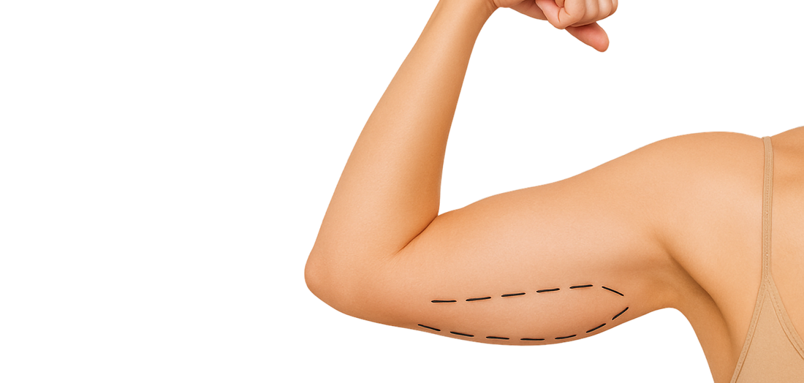 Липосакция рук