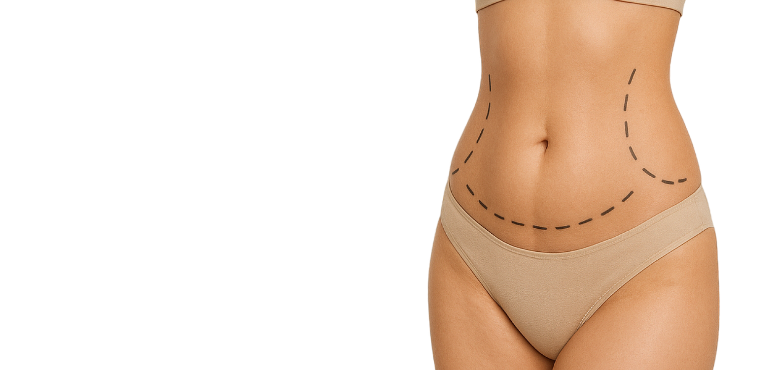Липосакция живота
